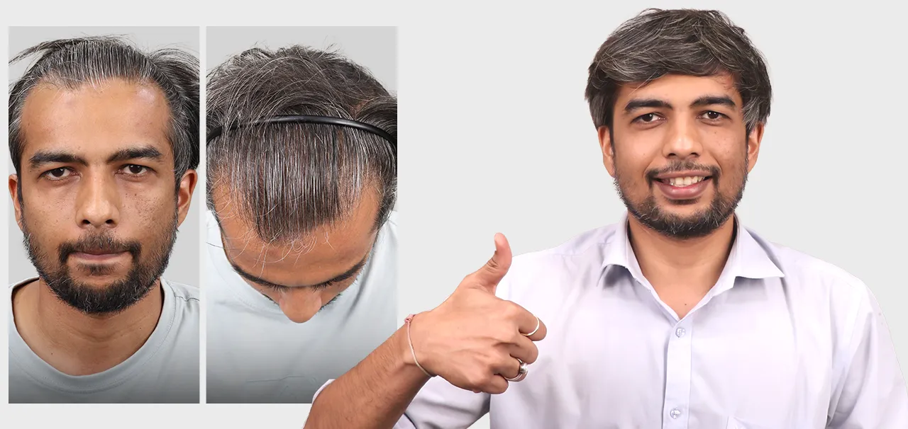 Amit P Patient Review – HairFree HairGrow Vapi