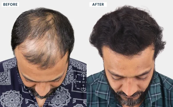 Before and after hair transplant photos of DHRUVESH B CHAUHAN highlighting natural hair growth and restored scalp coverage at HairFree HairGrow Vapi
