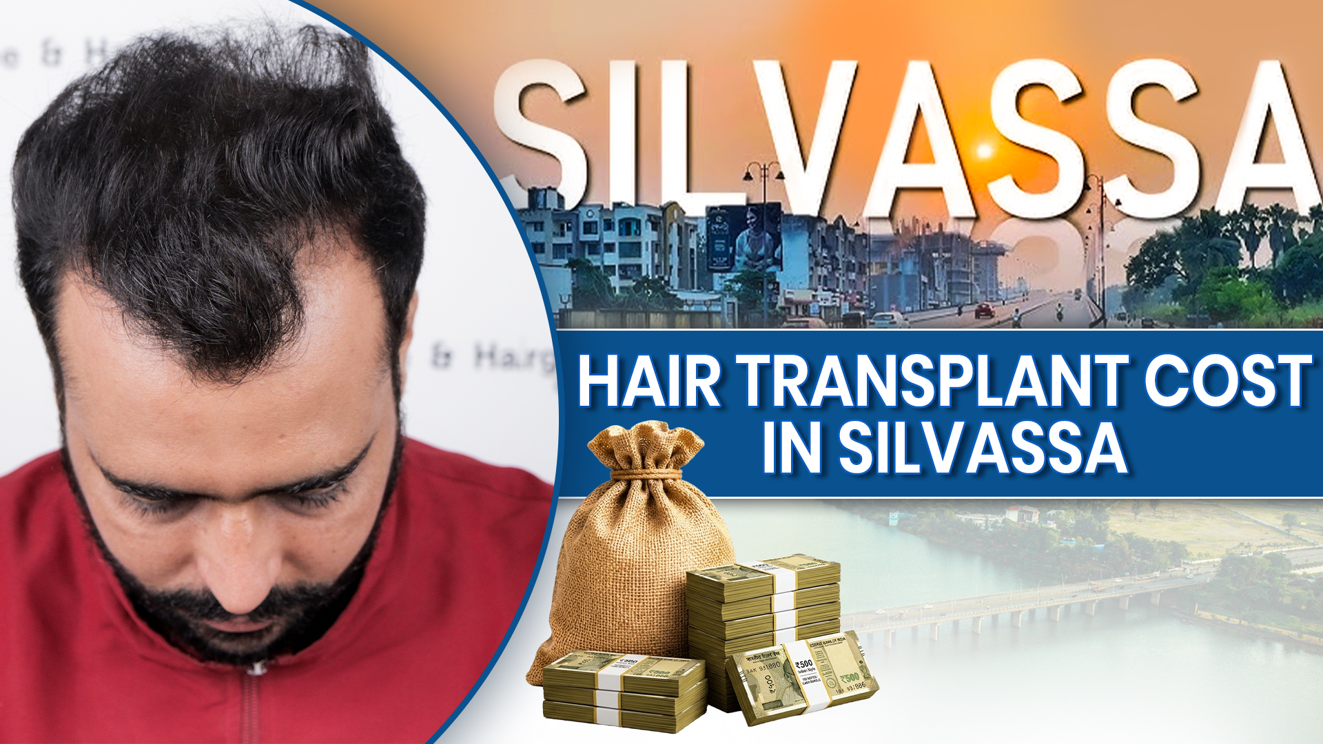Hair Transplant Cost in Silvassa with affordable pricing and expert care