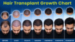 Hair transplant growth chart showing hair restoration progress from before treatment to 12 months