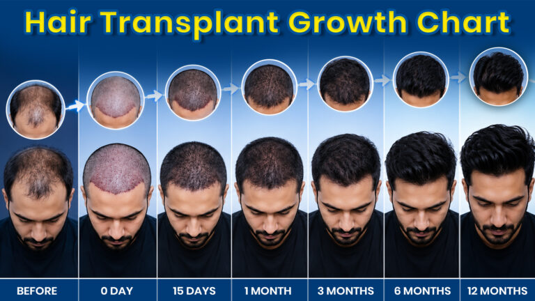 Hair transplant growth chart showing hair restoration progress from before treatment to 12 months