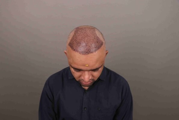 Hair Transplant Growth Chart showing the first 3 days after a hair transplant with newly placed grafts, mild swelling, redness, and graft protection during the initial healing stage.
