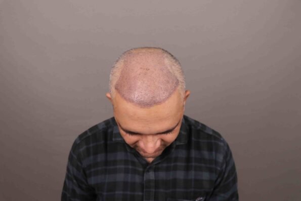Hair Transplant Growth Chart infographic showing scab formation around transplanted grafts during Days 4–7 as part of the normal healing process.
