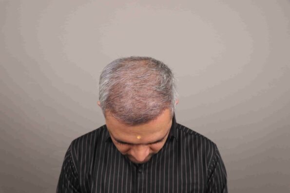Hair Transplant Growth Chart showing Month 3 with the first new hair strands beginning to grow from transplanted hair follicles.