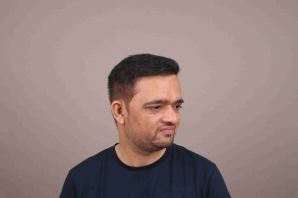 Hair Transplant Growth Chart showing Month 9 with fuller hair, improved thickness, and natural-looking hair transplant results.