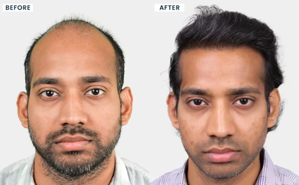 Hair Transplant in Silvassa before and after results of Aman Singh showing natural hairline restoration with Bio-FUE.