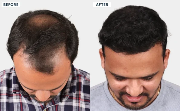 Hair Transplant in Silvassa before and after results of Harsh Panchal with improved hair density and natural-looking coverage.