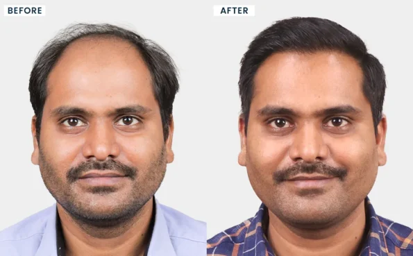 Hair Transplant in Silvassa before and after images of Mandeep Singh showing visible hair restoration results.