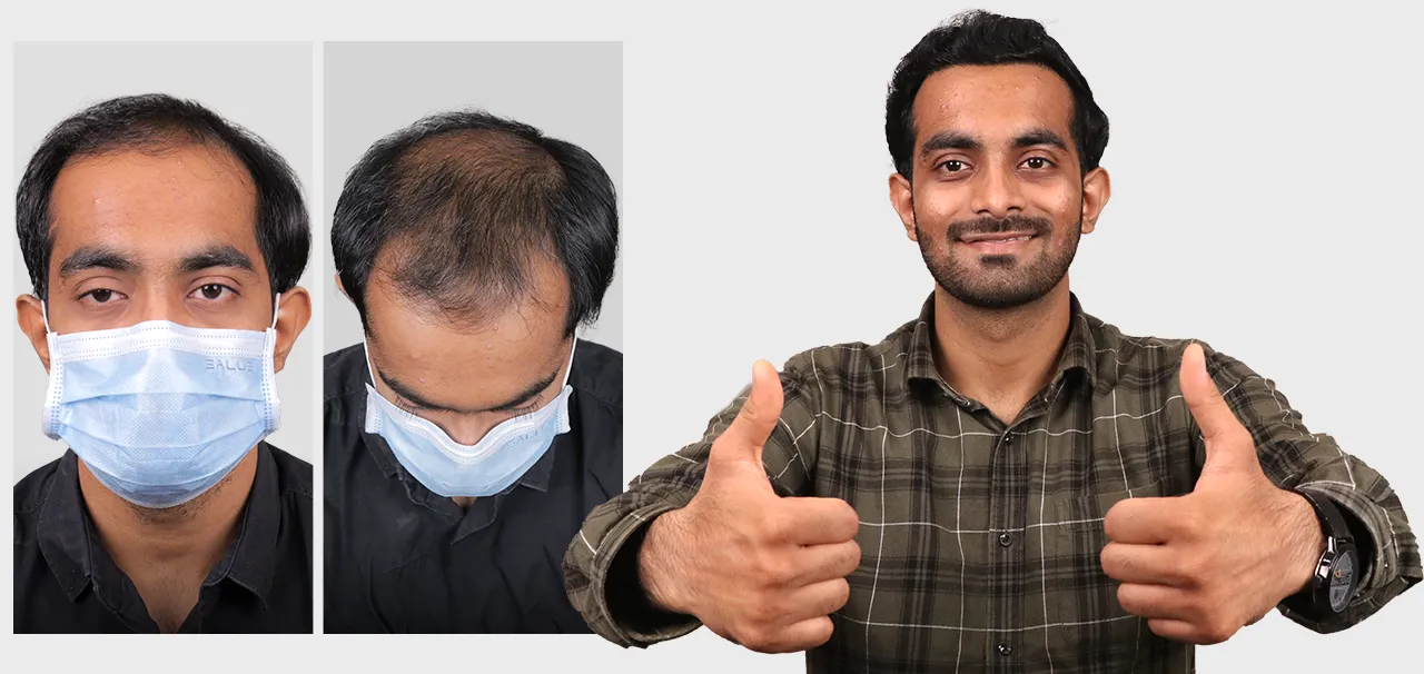 Hair Transplant in Silvassa patient review by Mustafa Rangwala after advanced Bio-FUE hair restoration.