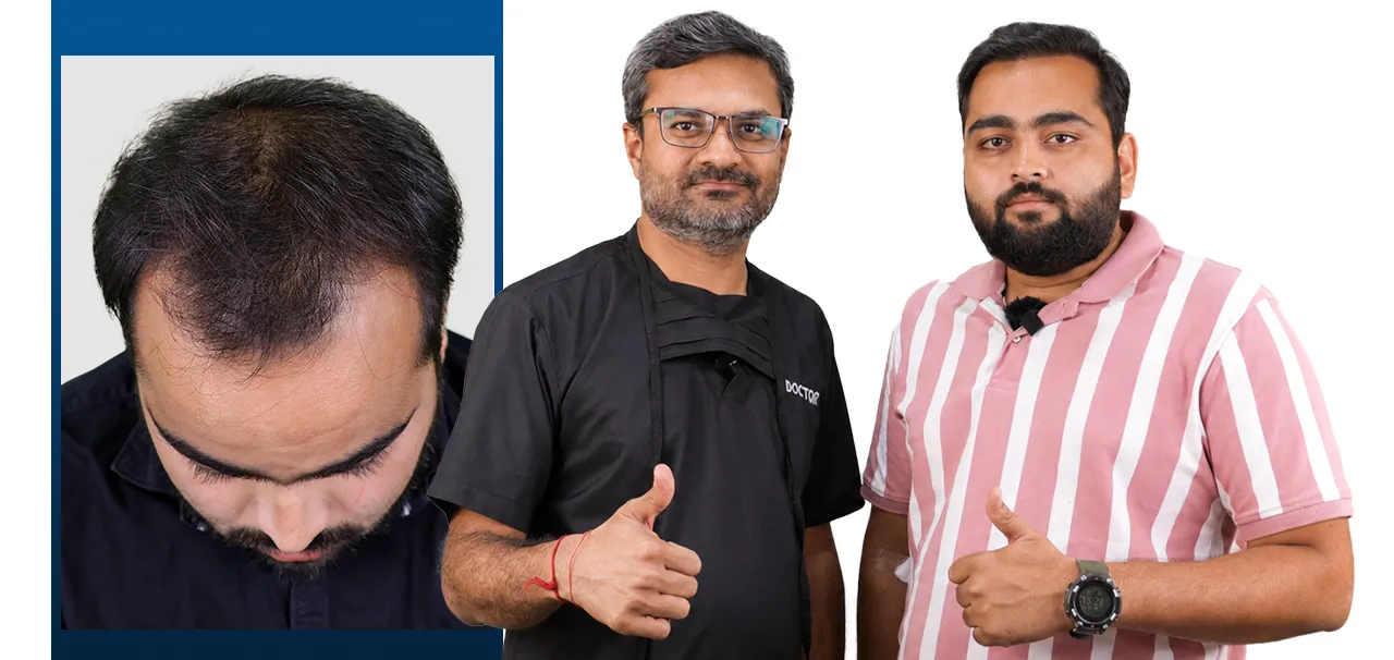 Hair Transplant in Silvassa review by Raghul Rajput discussing his Bio-FUE hair transplant results.