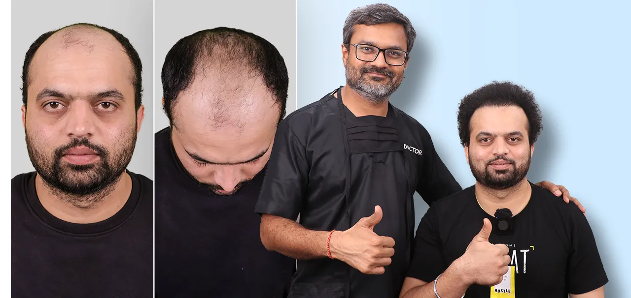Hair Transplant in Silvassa patient testimonial by Roni Kumar after Bio-FUE hair transplant treatment.
