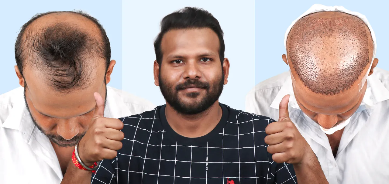 Hair Transplant in Silvassa patient review by Subhajit Talukder sharing his Bio-FUE hair restoration experience.