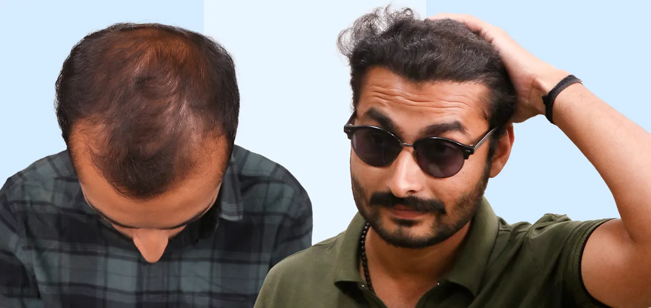 Harsh K Hair Transplant Patient Review