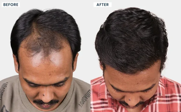 Before and after hair restoration results of NIRAJ SAROJ demonstrating enhanced hair density and a natural appearance at HairFree HairGrow Vapi