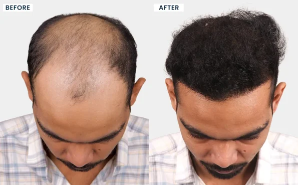 Before and after hair transplant images of NIRAJ WAGH showing visible improvement in hairline design and overall hair coverage at HairFree HairGrow Vapi