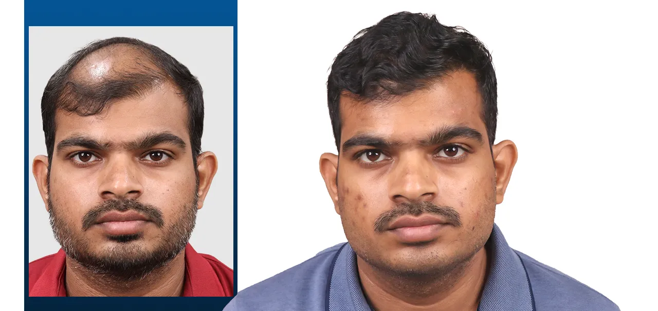 Nilesh R Patient Testimonial – HairFree HairGrow Vapi