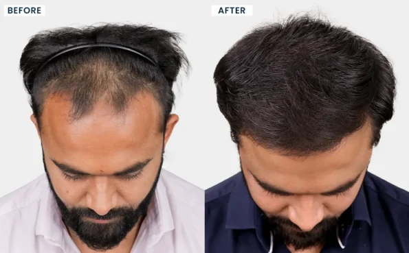 Before and after hair transplant results of PANKIL D KANANI showcasing fuller hair growth and natural-looking outcomes at HairFree HairGrow Vapi