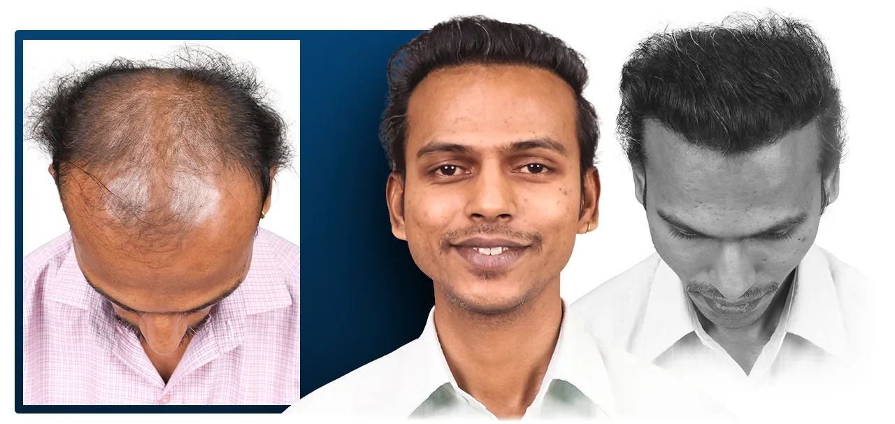 Rahul S Hair Restoration Review