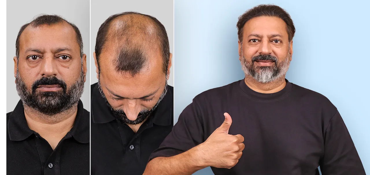 Vikram M Hair Transplant Testimonial