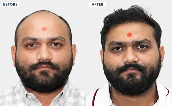 Before and after hair transplant results in Ahmedabad showing natural hairline restoration at HairFree HairGrow Clinic