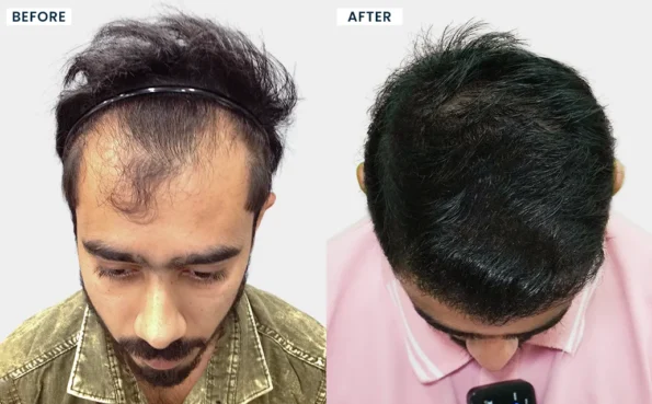 Real patient hair transplant results in Ahmedabad demonstrating natural hair growth after FUE hair transplant