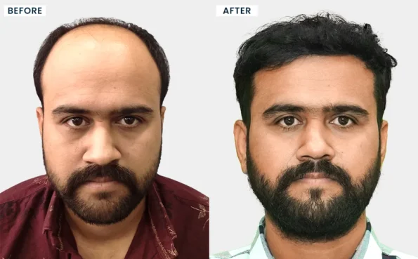 Before and after FUE hair transplant results in Ahmedabad at HairFree HairGrow Clinic