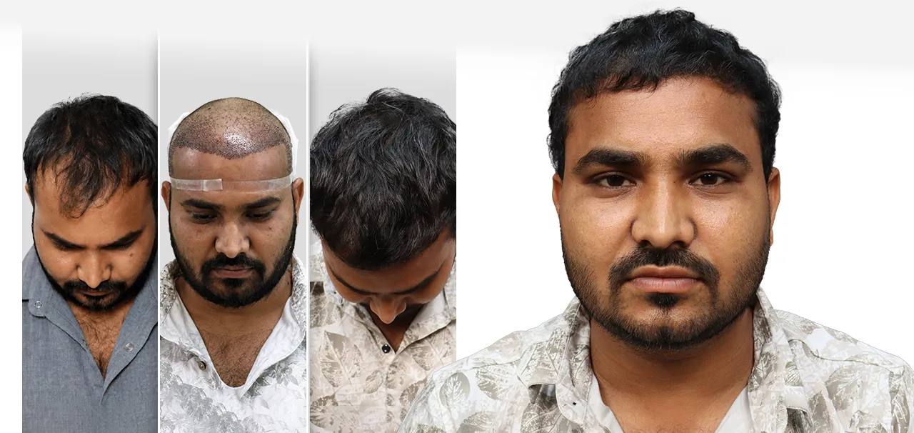 FUE hair transplant results and patient testimonial of Rahul Savant in Ahmedabad