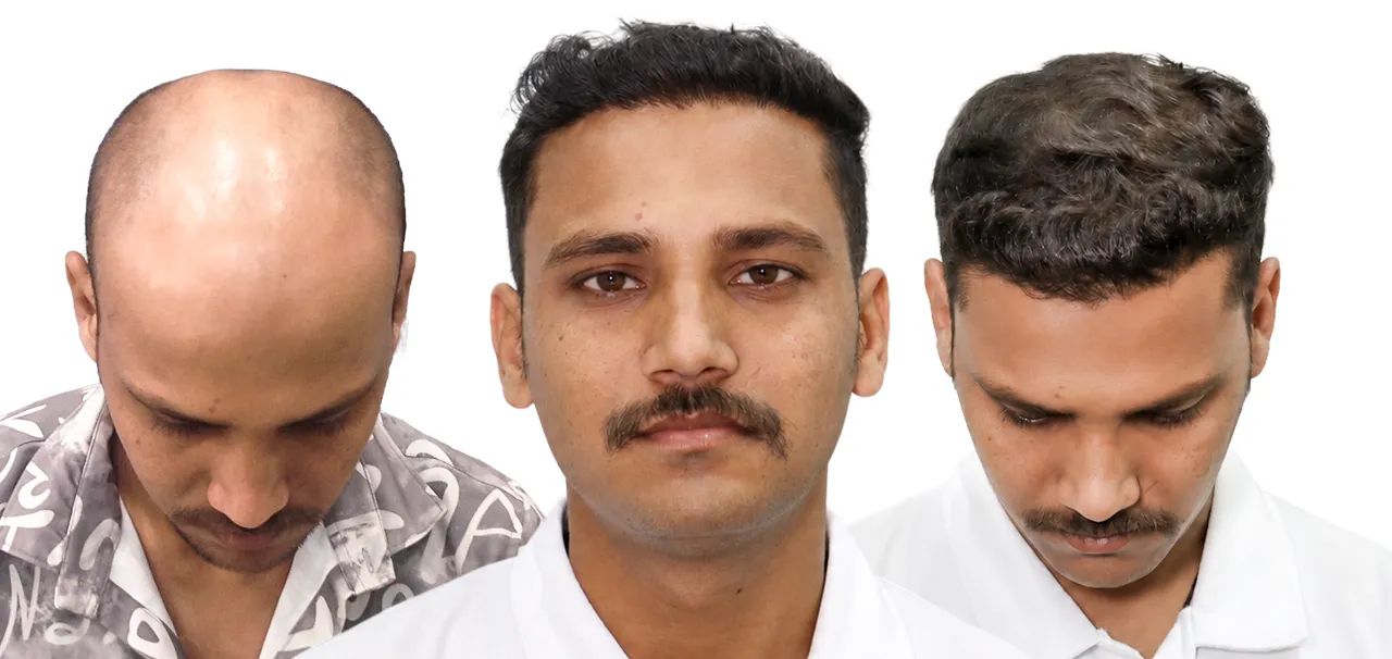 Hair transplant patient testimonial in Ahmedabad showing successful hair restoration results of Dharmendra Pradhan