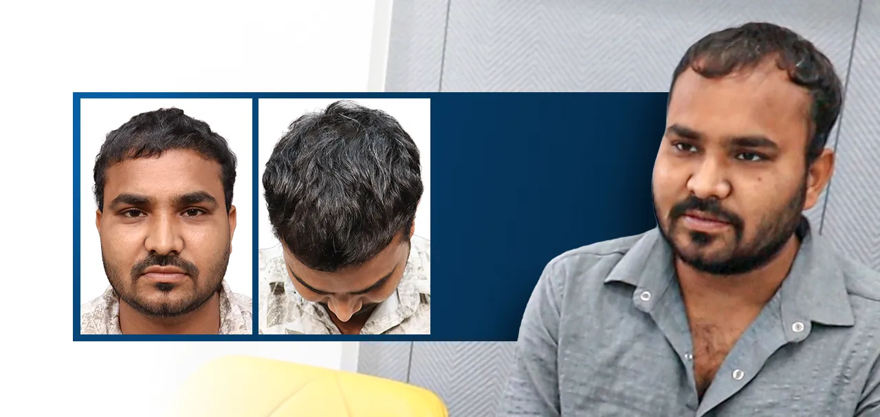Hair transplant success story and patient testimonial by Dipak Thakor after hair restoration treatment in Ahmedabad
