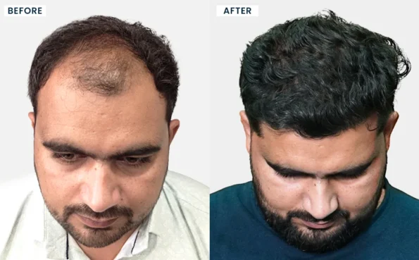 Hair transplant before and after results in Ahmedabad with improved hair density and natural-looking coverage