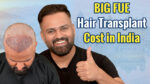 BIG FUE hair transplant cost in India with 2026 pricing and graft-based cost details.