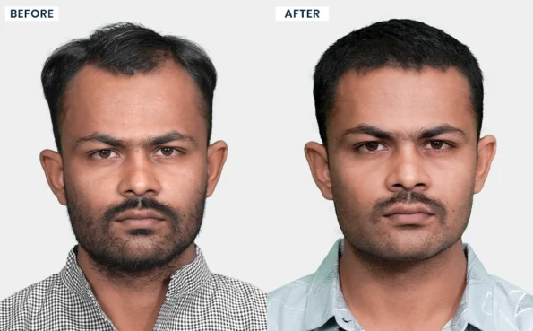 Bhagawat hair transplant before and after results showing front hairline and hair density improvement
