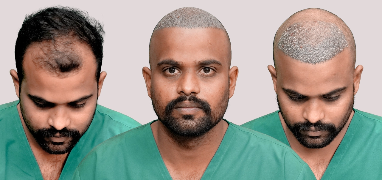 Dilip sharing his hair transplant treatment experience at HairFree HairGrow in Kharadi Pune