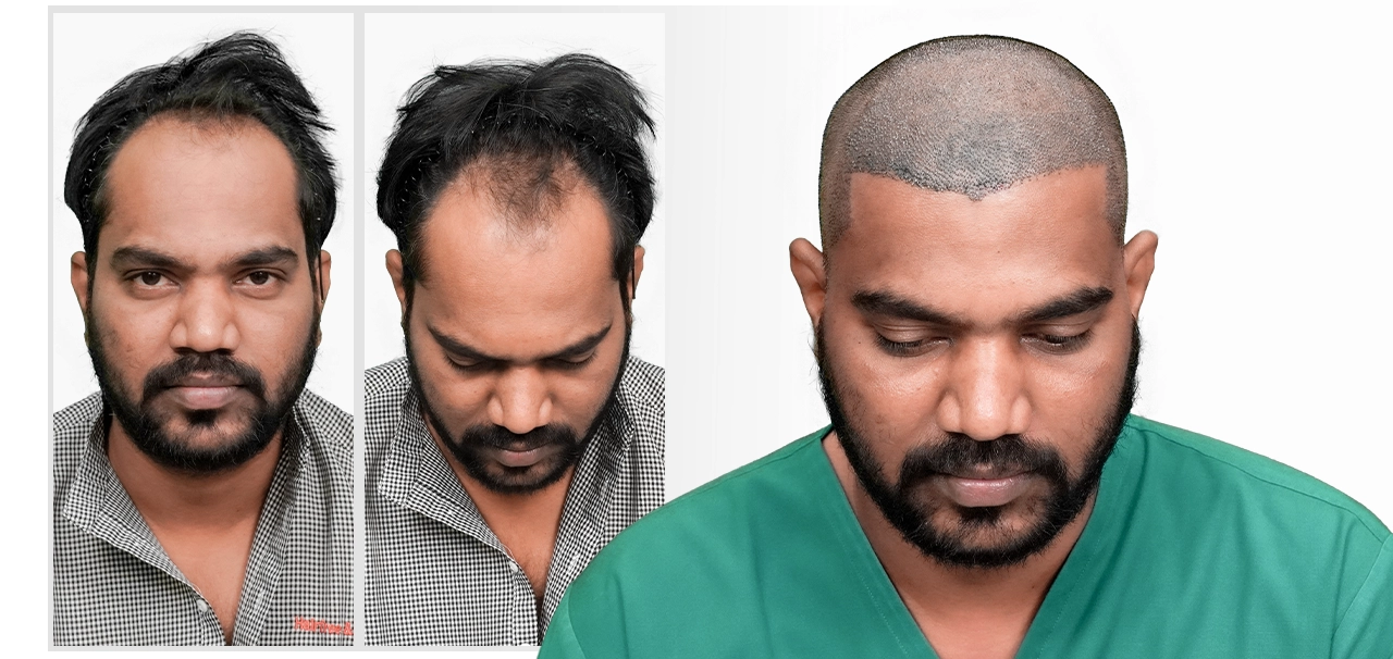 Durgesh sharing his experience after hair transplant treatment at HairFree HairGrow Kharadi Pune