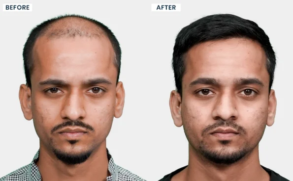 Ganesh M hair transplant before and after images showing improved hairline and hair density