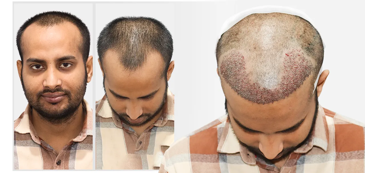 Hair Transplant in Mumbai patient review by Abhinav Jha sharing his experience, treatment journey, and satisfaction with the hair transplant results.