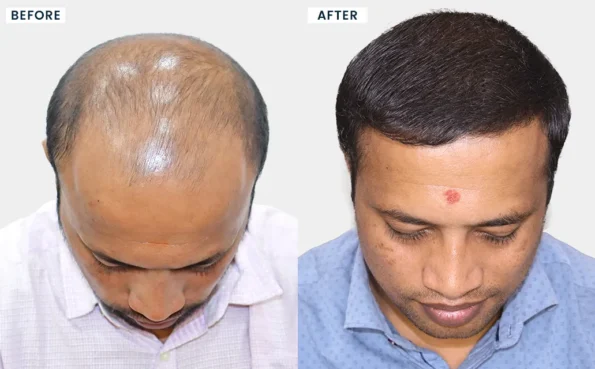 Hair Transplant in Mumbai before and after results of Akash Gawade showing natural hairline restoration and improved hair density after treatment.
