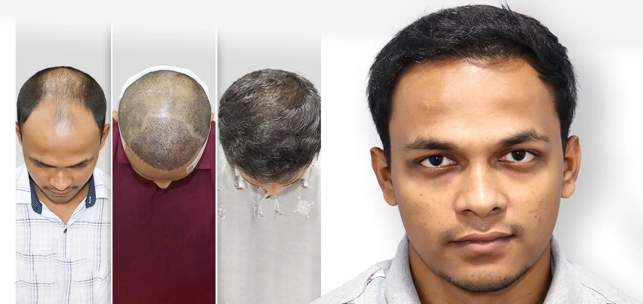 Hair Transplant in Mumbai testimonial by Bunty Nahak highlighting successful hair restoration, natural-looking results, and overall treatment experience.