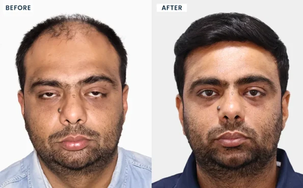 Hair Transplant in Mumbai before and after results of Kaid Arif Lakdawala showing successful hair restoration with natural-looking density and hairline improvement.