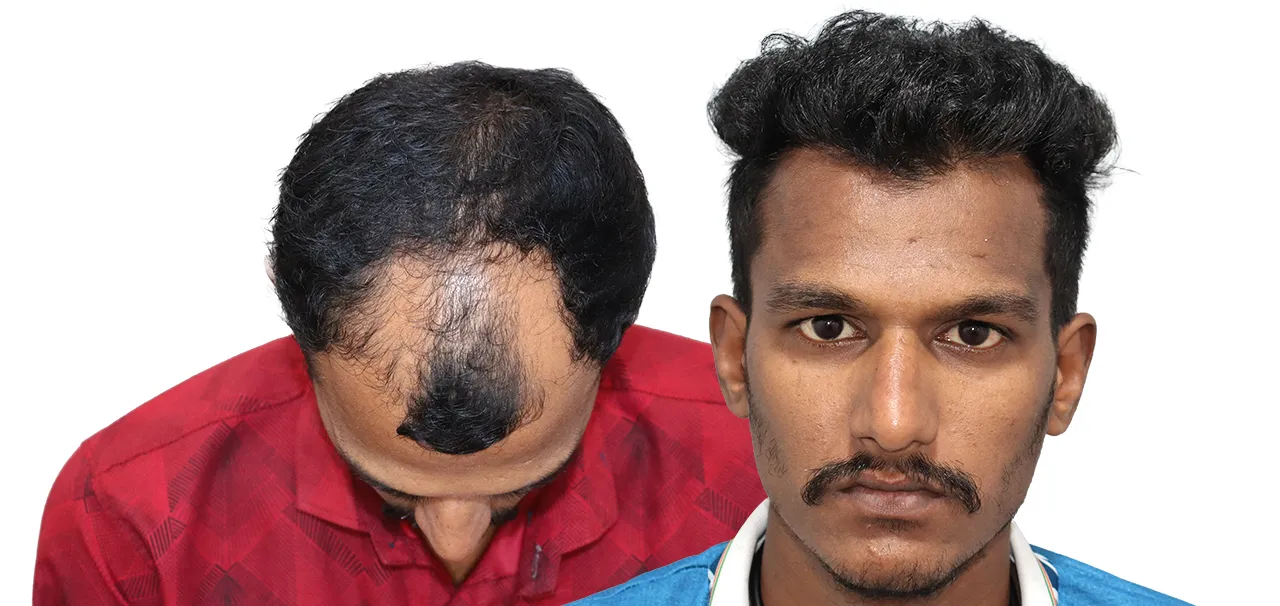 Hair Transplant in Mumbai review by Kunal Panhalkar describing his positive experience, professional care, and satisfaction with the hair transplant procedure.