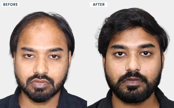 Hair Transplant in Mumbai before and after results of Mukesh Sahani demonstrating visible hair growth, improved scalp coverage, and natural-looking transplant results.