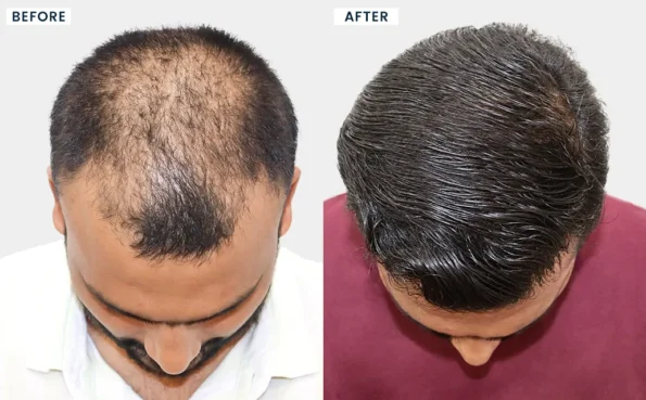 Hair Transplant in Mumbai before and after results of Niket Babhulkar showing enhanced hair density, restored hairline, and natural hair transplant outcome.