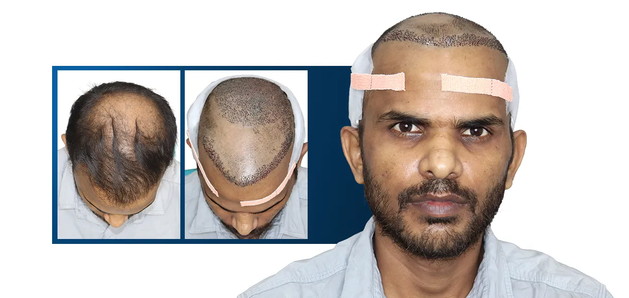Hair Transplant in Mumbai patient testimonial by Nilesh Bind sharing his hair restoration results and overall experience with the clinic.