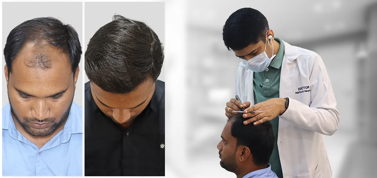 Hair Transplant in Mumbai review by Onkar Sirsulwar highlighting his treatment experience, natural hair transplant results, and patient satisfaction.