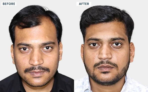 Hair Transplant in Mumbai before and after results of Pawan Dhumale showing significant hair regrowth, fuller hair coverage, and a natural-looking hairline.