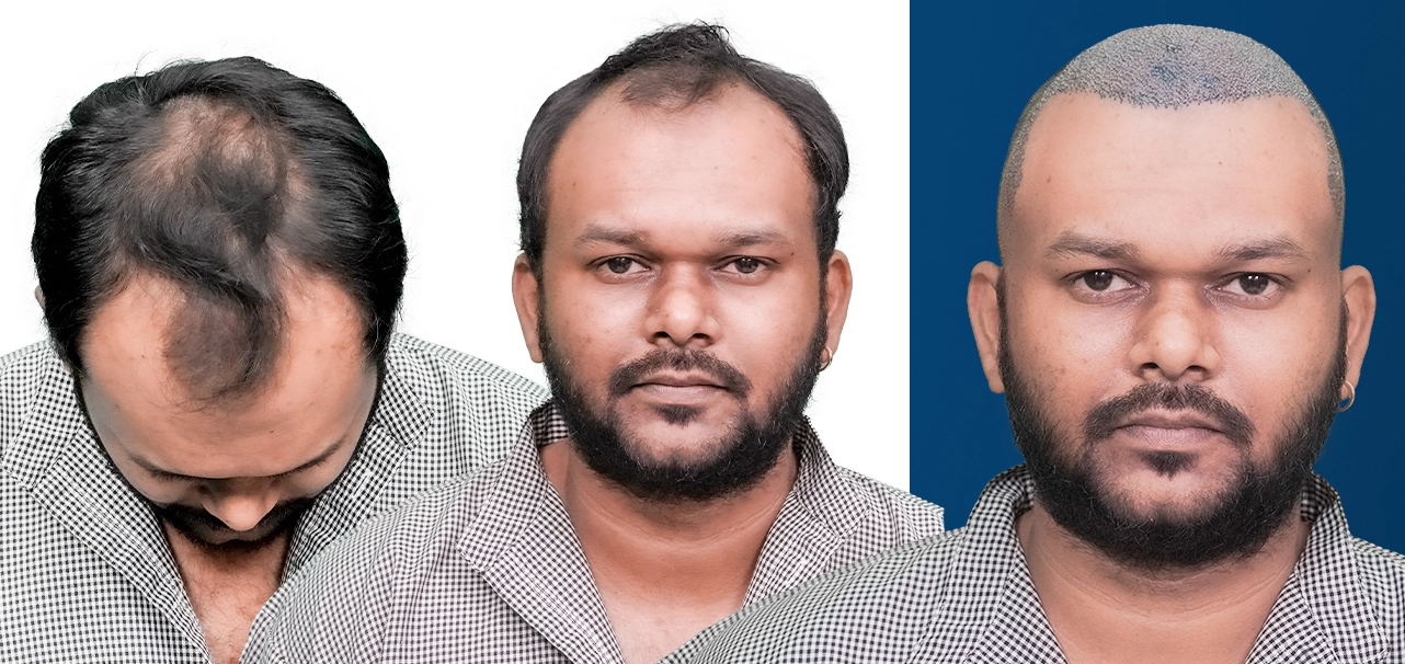 Karthik sharing his experience after hair transplant treatment at HairFree HairGrow Kharadi Pune