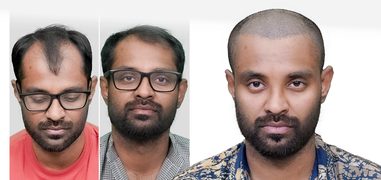 Kaushik Krishna sharing his experience after hair transplant treatment at HairFree HairGrow Kharadi Pune