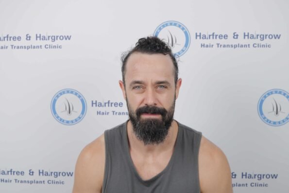 Kyle Paul Hair Transplant before surgery showing his Norwood 3/3A receding hairline prior to the 3,300-graft BIG-FUE hair transplant at HairFree HairGrow Clinic in Surat.