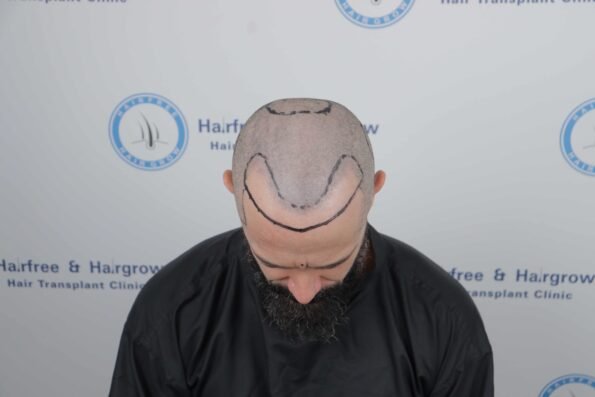 Kyle Paul Hair Transplant hairline marking before surgery showing the pre-operative hairline design for his 3,300-graft BIG-FUE procedure at HairFree HairGrow Clinic in Surat.