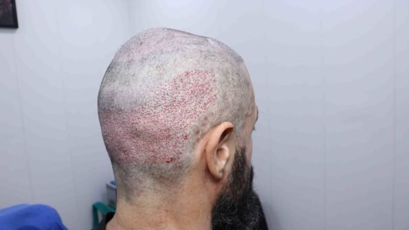 Kyle Paul Hair Transplant immediately after the 3,300-graft BIG-FUE procedure showing the newly implanted grafts and reconstructed hairline at HairFree HairGrow Clinic in Surat.